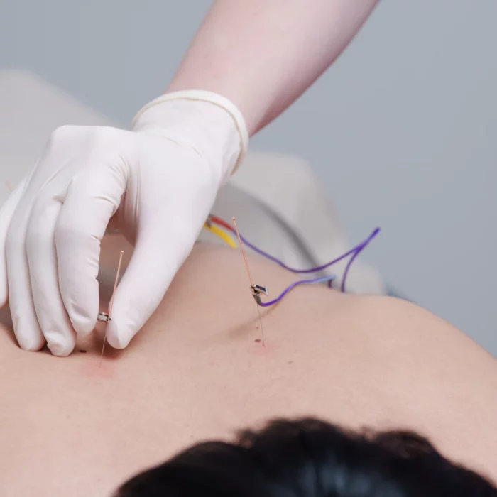 ฝังเข็ม Dry Needling-Acupuncture-05